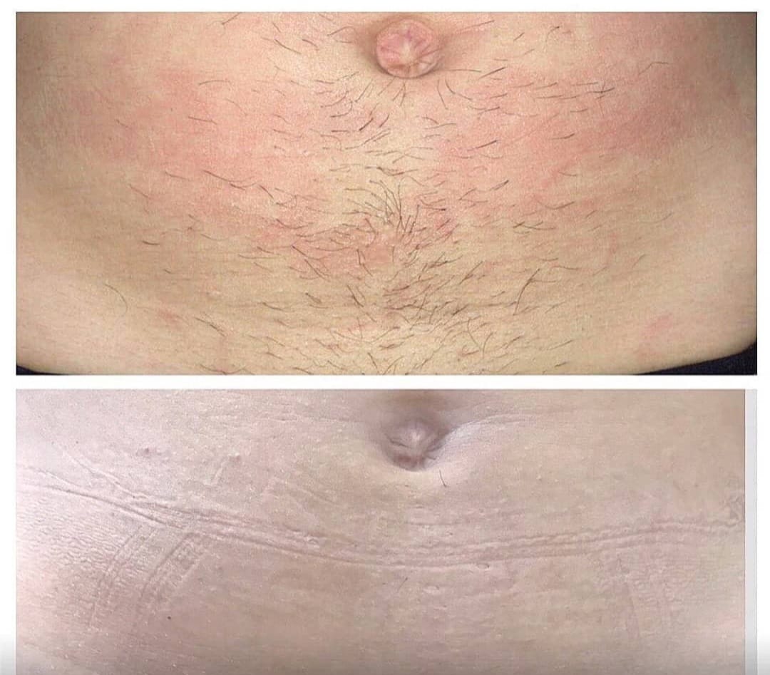 Voor en na resultaat laserontharing 3